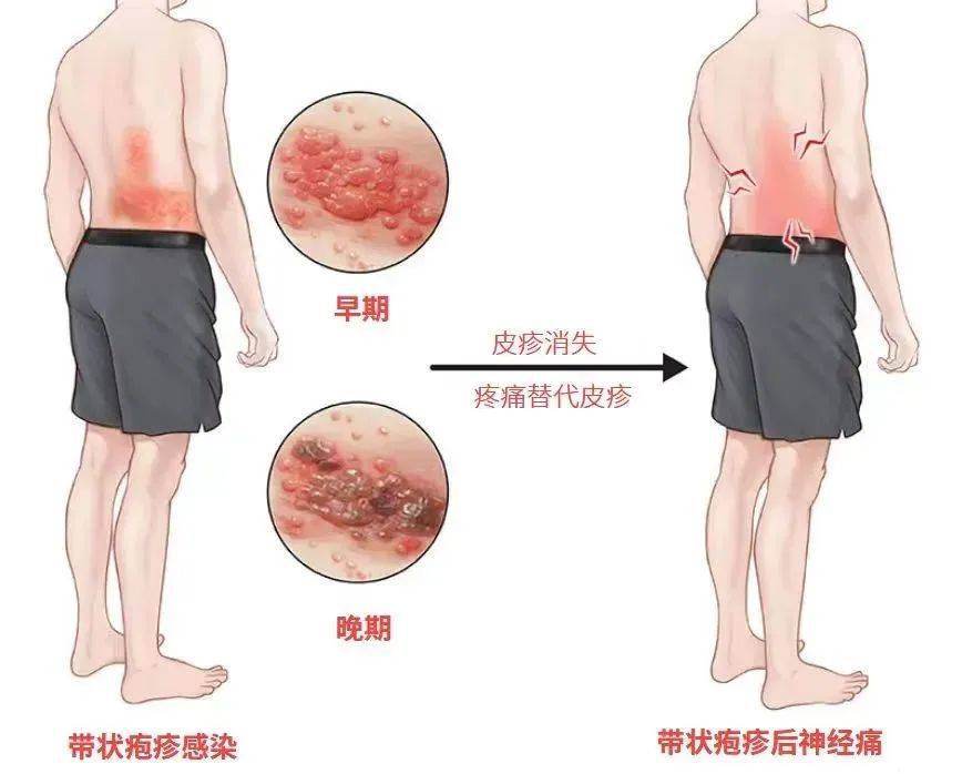 一旦感染终身携带<strong></p>
<p>摩登币</strong>！深圳疾控提醒：这4类人要注意