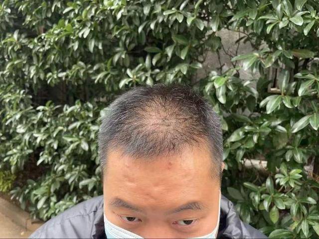 “还能反光<strong></p>
<p>炒币大师</strong>！”长沙男子植发近9月称后脑勺“像狗啃过”