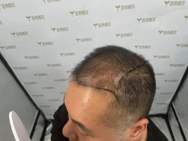 “还能反光<strong></p>
<p>炒币大师</strong>！”长沙男子植发近9月称后脑勺“像狗啃过”