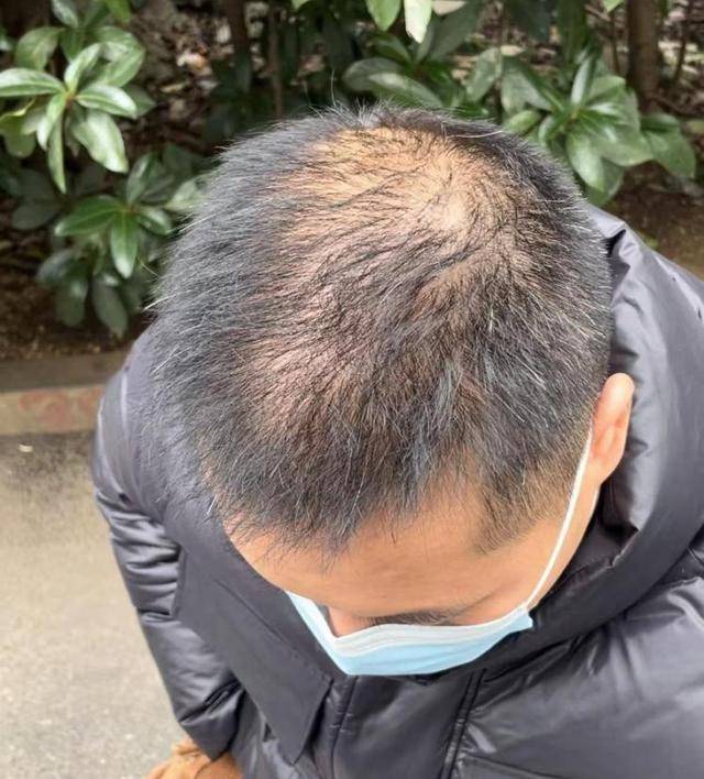 “还能反光<strong></p>
<p>炒币大师</strong>！”长沙男子植发近9月称后脑勺“像狗啃过”