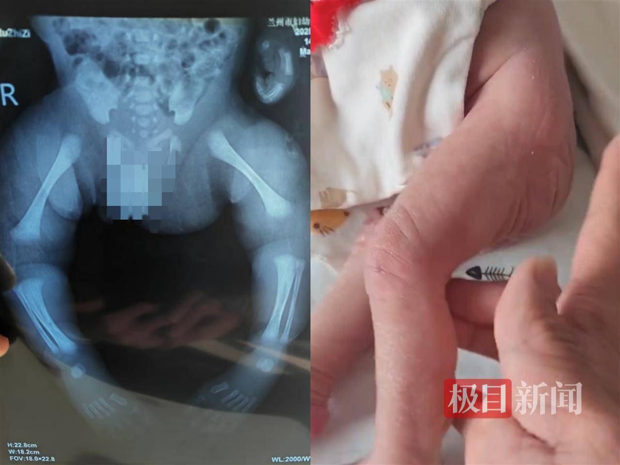 二胎出生查出先天性病症或落下残疾<strong></p>
<p>契约</strong>，残疾父母称医院产检漏检、未尽告知义务，医院及医调委回应