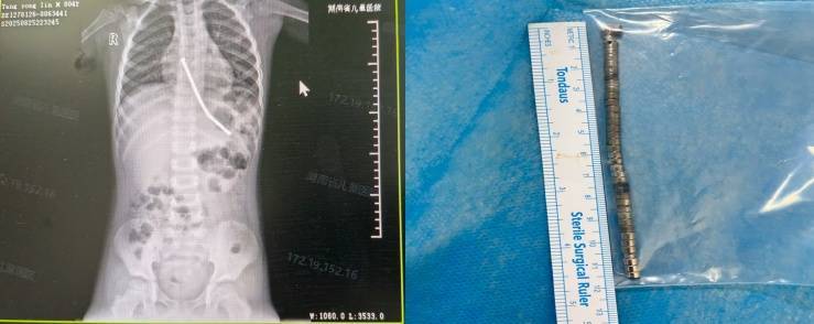 整整40颗<strong></p>
<p>比特币最新行情价格</strong>！湖南3岁男童身体里取出……医生紧急提醒