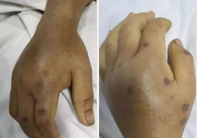 深圳一市民突遭马蜂围袭!已进入高发期<strong></p>
<p>比特币实时</strong>,千万别招惹!