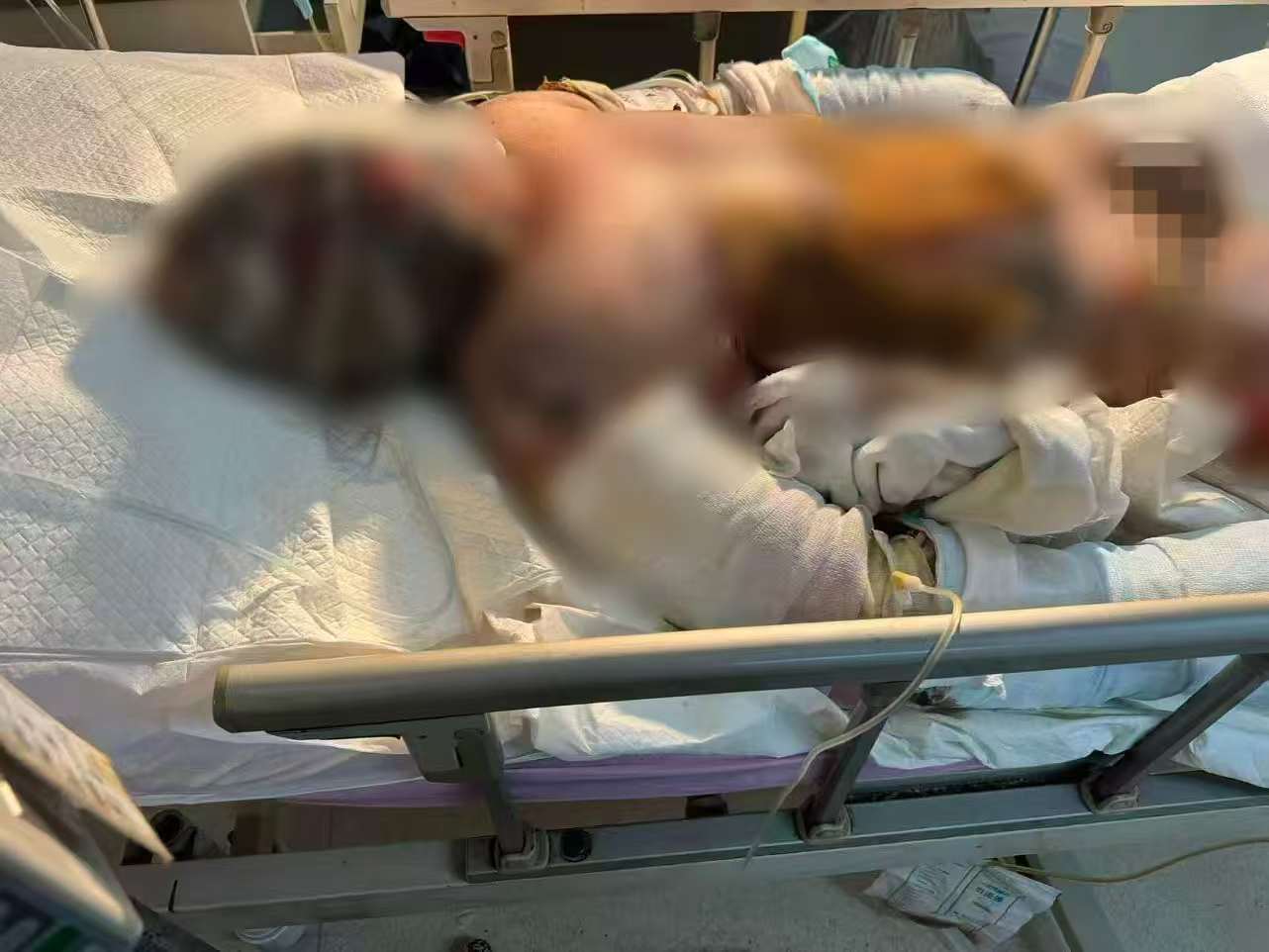 父子在哈尔滨一亲戚公司上班遇爆炸全身烧伤<strong></p>
<p>比特币实时</strong>,治疗花费近百万公司拒赔偿?亲戚回应