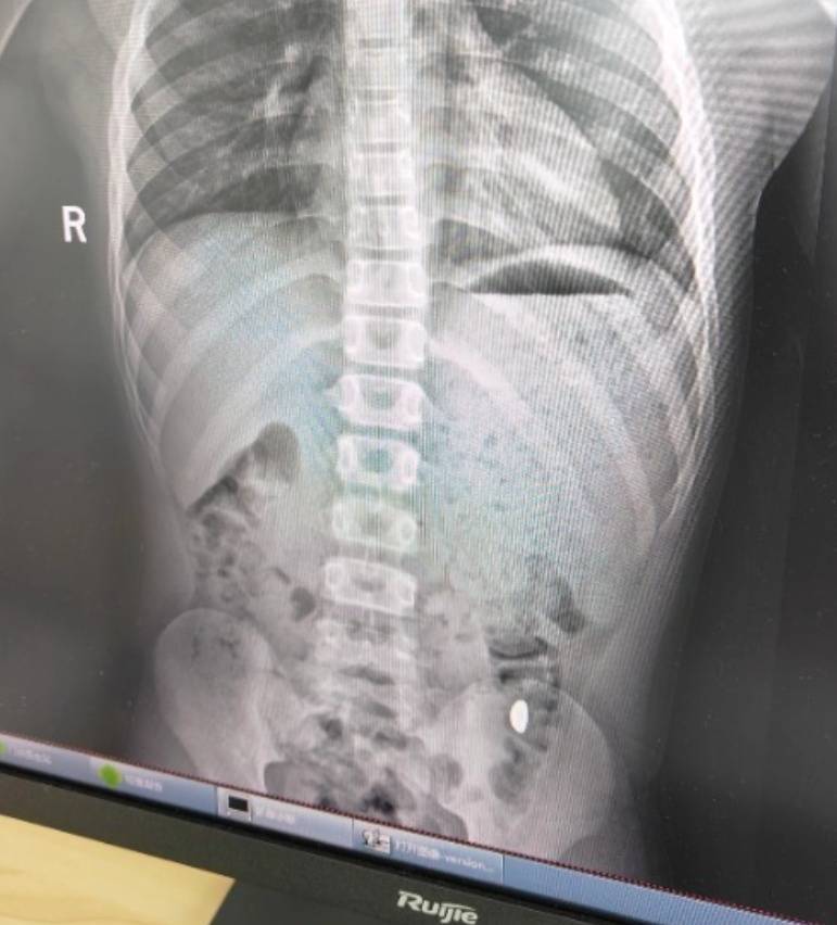 “熊孩子”误吞10克重金豆<strong></p>
<p>比特币目前价格</strong>,妈妈:天天叮嘱他不要在外面拉屎