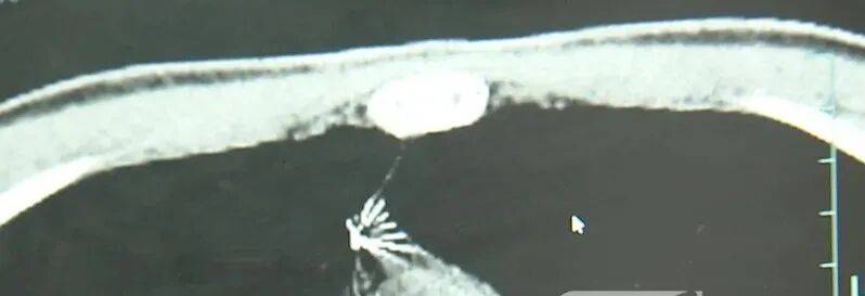 17岁小伙参军体检发现胸腔内有根5cm缝衣针<strong></p>
<p>比特币下载</strong>，父母回忆或是1岁时扎入，取出时已锈迹斑斑