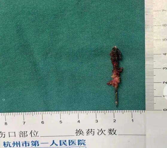 17岁小伙参军体检发现胸腔内有根5cm缝衣针<strong></p>
<p>比特币下载</strong>，父母回忆或是1岁时扎入，取出时已锈迹斑斑